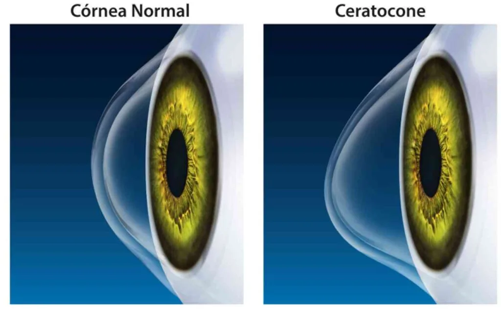 imagem que mostra de forma didática a diferença da córnea normal e da córnea com ceratocone